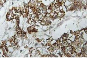 Immunohistochemistry (IHC) analyzes of HLA-DOalpha antibody in paraffin-embedded human breast carcinoma tissue. (HLA-DOA antibody)