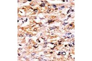 Formalin-fixed and paraffin-embedded human cancer tissue reacted with the primary antibody, which was peroxidase-conjugated to the secondary antibody, followed by AEC staining. (GCN2 antibody  (C-Term))