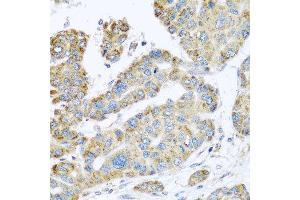Immunohistochemistry of paraffin-embedded human liver cancer using SYT4 antibody at dilution of 1:100 (x40 lens).