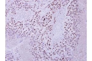 IHC-P Image Immunohistochemical analysis of paraffin-embedded H661 xenograft, using ZNF217 antibody [N3C2], Internal, antibody at 1:250 dilution. (ZNF217 antibody)