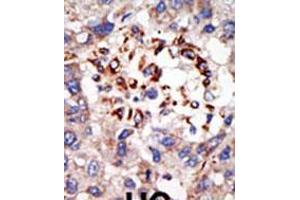 Formalin-fixed and paraffin-embedded human cancer tissue reacted with the primary antibody, which was peroxidase-conjugated to the secondary antibody, followed by DAB staining. (CBX8 antibody  (C-Term))
