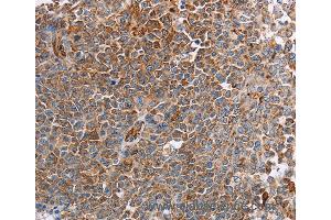 Immunohistochemistry of Human liver cancer using PLXNA2 Polyclonal Antibody at dilution of 1:40