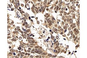 Immunohistochemistry analysis of paraffin-embedded human lung cancer using p27 Polyclonal Antibody at dilution of 1:200.