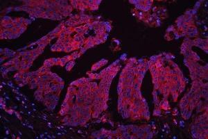 IF analysis of MPS1 using anti-MPS1 antibody (ABIN4886714) MPS1 was detected in paraffin-embedded section of human ovarian cancer tissues. (RPS27 antibody  (AA 2-84))