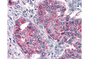 Anti-T1R3 / TAS1R3 antibody IHC of human Lung, Non-Small Cell Carcinoma. (TAS1R3 antibody  (N-Term))