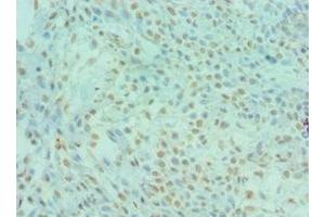 Immunohistochemistry of paraffin-embedded human breast cancer using ABIN7150791 at dilution of 1:100 (DYRK2 antibody  (AA 502-601))
