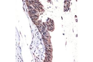 Immunohistochemistry of paraffin-embedded human colon carcinoma using MBD3 Rabbit mAb (ABIN7268492) at dilution of 1:100 (40x lens). (MBD3 antibody)