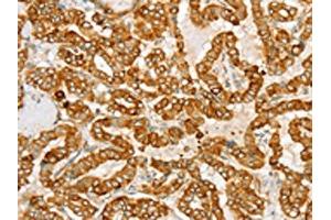 The image on the left is immunohistochemistry of paraffin-embedded Human thyroid cancer tissue using ABIN7130771(PTPN22 Antibody) at dilution 1/20, on the right is treated with fusion protein. (PTPN22 antibody)