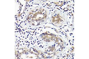 Immunohistochemistry of paraffin-embedded human breast cancer using IMPDH2 Rabbit pAb (ABIN7267853) at dilution of 1:100 (40x lens). (IMPDH2 antibody  (AA 215-514))
