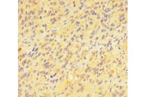 Immunohistochemistry of paraffin-embedded human glioma using ABIN7163391 at dilution of 1:100 (PAG1 antibody  (AA 97-432))