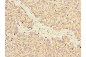 Immunohistochemistry of paraffin-embedded human ovarian cancer using ABIN7167152 at dilution of 1:100