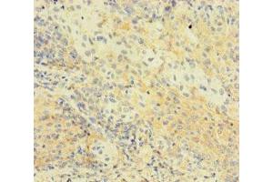 Immunohistochemistry of paraffin-embedded human cervical cancer using ABIN7174776 at dilution of 1:100 (C1orf112 antibody  (AA 301-530))