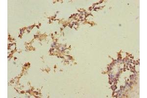Immunohistochemistry of paraffin-embedded human breast cancer using ABIN7159424 at dilution of 1:100