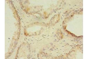 Immunohistochemistry of paraffin-embedded human prostate cancer using ABIN7176347 at dilution of 1:100 (ZNF501 antibody  (AA 6-305))