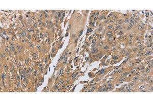 Immunohistochemistry of paraffin-embedded Human lung cancer using PTPN12 Polyclonal Antibody at dilution of 1:45 (PTPN12 antibody)