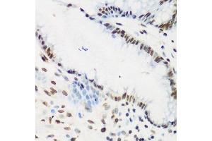 Immunohistochemistry of paraffin-embedded human stomach cancer using KLF4 antibody. (KLF4 antibody  (AA 180-479))