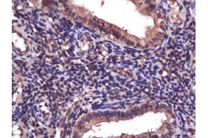 Formalin-fixed and paraffin embedded human endometrium carcinoma labeled with Anti-PI3K/PI3 kinase p85 alpha subunit Polyclonal Antibody, Unconjugated (ABIN725405) at 1:200 followed by conjugation to the secondary antibody and DAB staining. (PIK3R1 antibody  (AA 501-600))