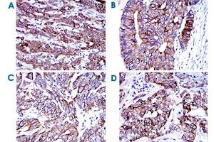 Immunohistochemical analysis of paraffin-embedded human cervical cancer (A) , human colon cancer (B) , human stomach cancer (C) and human bladder cancer (D) tissues using KRT19 monoclonal antibody, clone 4E8  with DAB staining.
