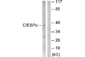 Immunohistochemical analysis of paraffin-embedded human lung carcinoma tissue, using C/EBP-α (Ab-21) antibody. (CEBPA antibody)