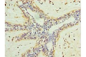 Immunohistochemistry of paraffin-embedded human breast cancer using ABIN7158005 at dilution of 1:100 (L3MBTL1 antibody  (AA 513-752))
