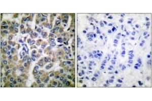 Immunohistochemistry analysis of paraffin-embedded human breast carcinoma tissue, using HSP10 Antibody. (HSPE1 antibody  (AA 51-100))