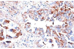 Immunohistochemistry of paraffin-embedded Human lung cancer using TIM-3/HAVCR2 Polyclonal Antibody at dilution of 1:200 (40x lens). (TIM3 antibody)