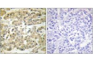 Immunohistochemistry analysis of paraffin-embedded human breast carcinoma, using 14-3-3 zeta (Phospho-Ser58) Antibody. (14-3-3 zeta antibody  (pSer58))
