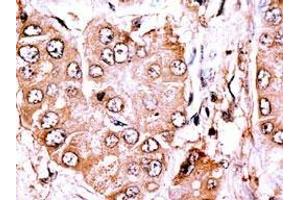 Formalin-fixed and paraffin-embedded human Hepatocellular carcinoma reacted with anti-CLASP2 Antibody (C-term), which was peroxidase-conjugated to the secondary antibody, followed by DAB staining. (CLASP2 antibody  (C-Term))