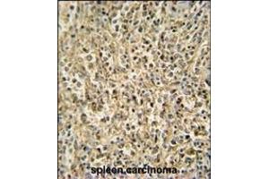 RNT2 antibody (N-term) (ABIN654720 and ABIN2844409) immunohistochemistry analysis in formalin fixed and paraffin embedded human spleen carcinoma followed by peroxidase conjugation of the secondary antibody and DAB staining. (RNASET2 antibody  (N-Term))