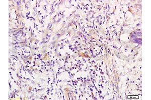 Formalin-fixed and paraffin embedded human colon carcinoma tissue labeled with Anti-RRM1 Polyclonal Antibody, Unconjugated (ABIN731543) at 1:200 followed by conjugation to the secondary antibody, (SP-0023), and DAB staining