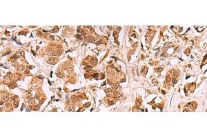 Immunohistochemistry of paraffin-embedded Human breast cancer tissue using RRP8 Polyclonal Antibody at dilution of 1:80(x200) (RRP8 antibody)