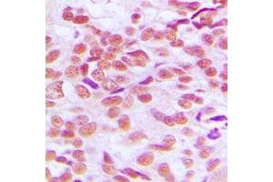 Immunohistochemical analysis of GSK3 alpha/beta staining in human breast cancer formalin fixed paraffin embedded tissue section. (GSK3 alpha/beta antibody  (Center))