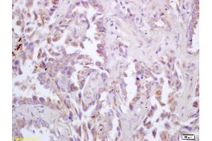 Formalin-fixed and paraffin embedded human lung carcinoma labeled with Rabbit Anti ChRM3/Acetylcholine receptor(M3) Polyclonal Antibody, Unconjugated (ABIN674484) at 1:200 followed by conjugation to the secondary antibody and DAB staining (CHRM3 antibody  (AA 481-589))
