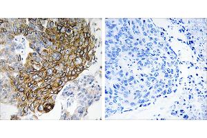 Peptide - +Immunohistochemistry analysis of paraffin-embedded human lung carcinoma tissue using GJA3 antibody. (GJA3 antibody  (Internal Region))
