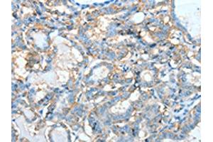 The image on the left is immunohistochemistry of paraffin-embedded Human thyroid cancer tissue using ABIN7128285(AGBL3 Antibody) at dilution 1/45, on the right is treated with fusion protein. (AGBL3 antibody)
