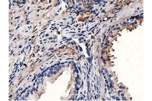 Immunohistochemical staining of paraffin-embedded Adenocarcinoma of Human colon tissue using anti-MICAL1 mouse monoclonal antibody.