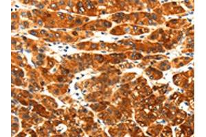 The image on the left is immunohistochemistry of paraffin-embedded Human liver cancer tissue using ABIN7191931(PLXNA3 Antibody) at dilution 1/25, on the right is treated with synthetic peptide. (Plexin A3 antibody)