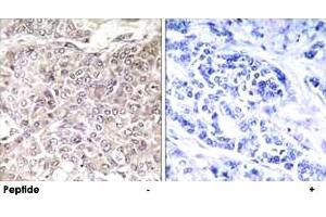 Immunohistochemistry analysis of paraffin-embedded human breast carcinoma tissue using GPRIN3 polyclonal antibody . (GPRIN3 antibody)