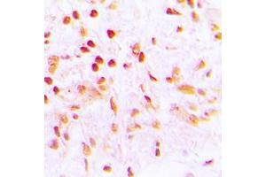 Immunohistochemical analysis of CDCA2 staining in human lung cancer formalin fixed paraffin embedded tissue section. (CDCA2 antibody  (Center))