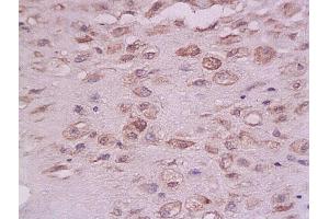 Formalin-fixed and paraffin embedded: human endometrium tissue labeled with Anti-PTP-1B Polyclonal Antibody (ABIN725975), Unconjugated at 1:200 followed by conjugation to the secondary antibody and DAB staining (PTPN1 antibody  (AA 1-100))