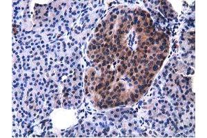 Immunohistochemical staining of paraffin-embedded Carcinoma of Human lung tissue using anti-VWA5A mouse monoclonal antibody. (VWA5A antibody)