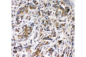 Anti-VRL1 antibody, IHC(P) IHC(P): Human Intestinal Cancer Tissue (TRPV2 antibody  (N-Term))