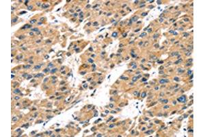 The image on the left is immunohistochemistry of paraffin-embedded Human liver cancer tissue using ABIN7192934(TRPV5 Antibody) at dilution 1/25, on the right is treated with synthetic peptide. (TRPV5 antibody)