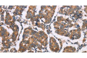 Immunohistochemistry of paraffin-embedded Human breast cancer tissue using ELP3 Polyclonal Antibody at dilution of 1:35 (ELP3/KAT9 antibody)