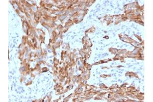 Formalin-fixed, paraffin-embedded human Lung Carcinoma stained with Cytokeratin-7 Mouse Monoclonal Antibody (KRT7/2200).