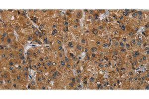 Immunohistochemistry of paraffin-embedded Human liver cancer using HSD3B7 Polyclonal Antibody at dilution of 1:40 (HSD3B7 antibody)