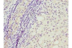 Immunohistochemistry of paraffin-embedded human liver cancer using ABIN7162470 at dilution of 1:100