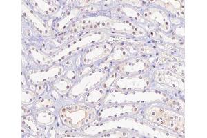 ABIN6267506 at 1/100 staining human kidney carcinoma tissue sections by IHC-P. (HNF4A antibody  (pSer313))