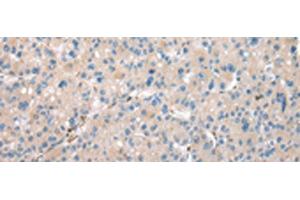 Immunohistochemistry of paraffin-embedded Human liver cancer tissue using DCAF7 Polyclonal Antibody at dilution of 1:30(x200) (DCAF7 antibody)