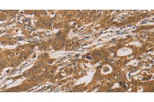Immunohistochemistry of paraffin-embedded Human gastric cancer tissue using CYP17A1 Polyclonal Antibody at dilution 1:30 (CYP17A1 antibody)